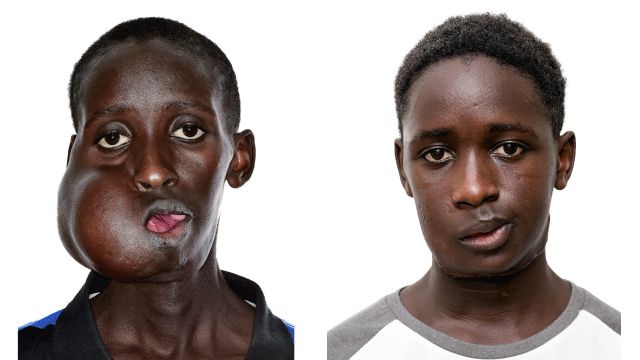 Una acción solidaria de Vithas, el Dr. Solís y la Asociación GUP salva la vida a un adolescente senegalés tras extirparle un tumor facial de 20 cm - 1, Foto 1