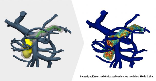 La IA aplicada a modelos 3D podría predecir qué tumores de páncreas derivarán en malignos - 1, Foto 1