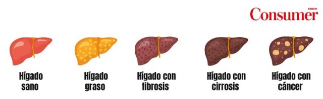 Consumer analiza las claves del aumento de la enfermedad del hígado no graso - 1, Foto 1