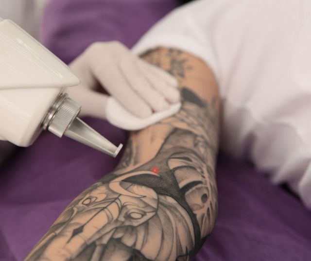 Eliminación de tatuajes - 1, Foto 1