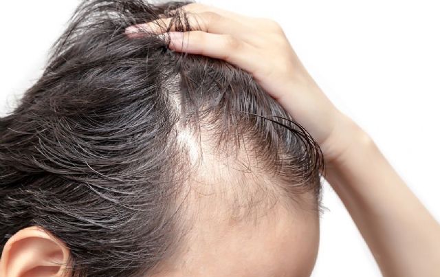 Farmacia Market, contra la alopecia: hasta un 50% de descuentos en su gama de productos anticaída - 1, Foto 1