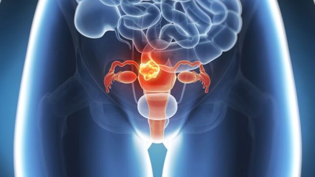 La mayoría de los casos de cáncer de útero en mujeres jóvenes se detectan durante los tratamientos de infertilidad - 1, Foto 1