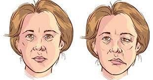 La cirugía permite mejorar la calidad de vida y la autoestima de los pacientes con parálisis facial - 1, Foto 1