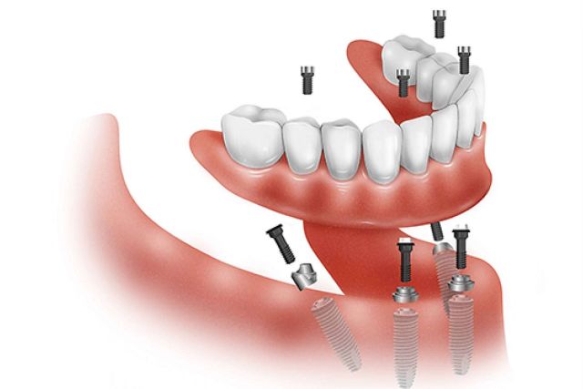 All On 4 y All On 6, las prótesis dentales híbridas de Clínica Dental Ruiz de Gopegui que devuelven la sonrisa en 24 horas - 1, Foto 1