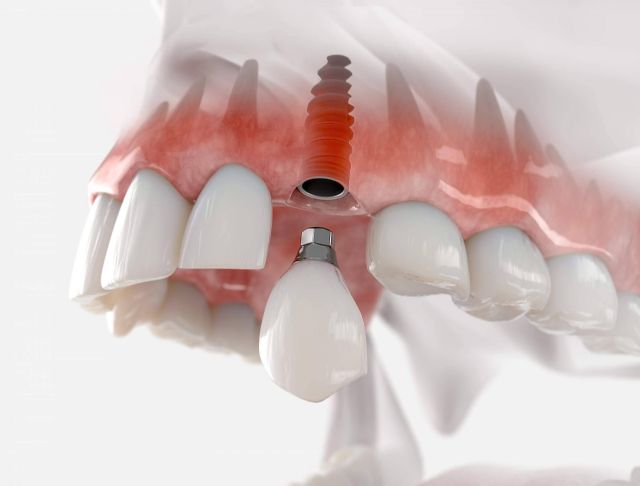 La técnica por la que apuesta Clínica Dental Sonrisas para conseguir una dentadura de 10 en sus pacientes, implantes postextracción con carga inmediata - 1, Foto 1