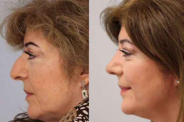 Qué hacer antes de pasar por una rinoplastia ultrasónica, por el Dr. Pérez Villar - 1, Foto 1