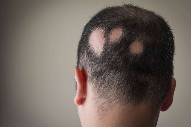 Combatir la alopecia areata con Saw Palmetto y su tratamiento - 1, Foto 1