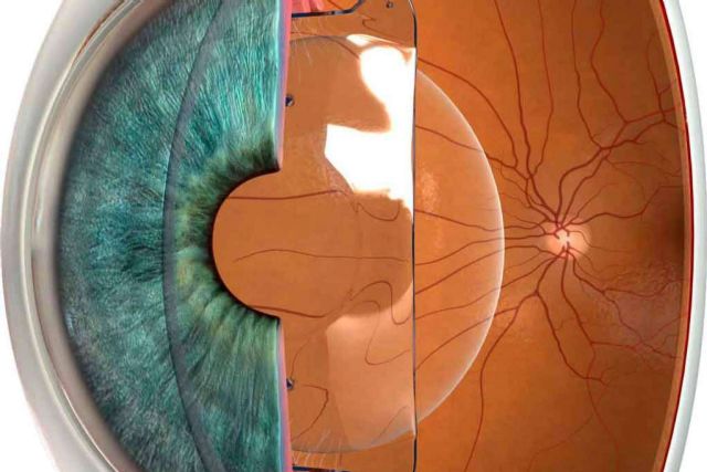 ¿Cómo funciona la cirugía refractiva? - 1, Foto 1