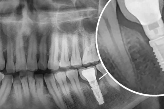 Implantes dentales en la clínica dental del Dr. Román Hernández para recuperar la funcionalidad de la boca - 1, Foto 1