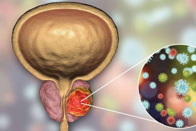 Capenergy afirma que superar las consecuencias de un cáncer de próstata es posible - 1, Foto 1