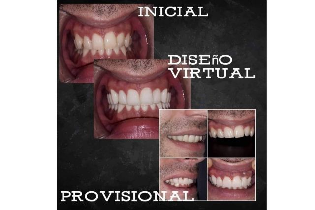 Dentinova ofrece alineación dentaria sin ortodoncia - 1, Foto 1