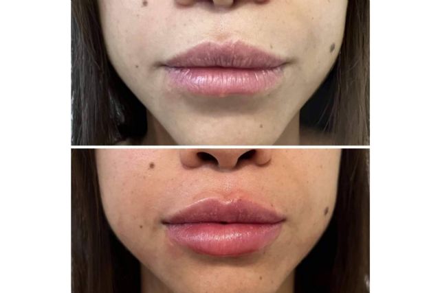 ¿Es posible realizarse un aumento de labios en Madrid con resultados naturales?, por la Dra. Cecilia Arthur - 1, Foto 1