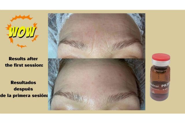 ¿Qué es el peeling químico? ¿Es recomendable realizárselo? - 1, Foto 1