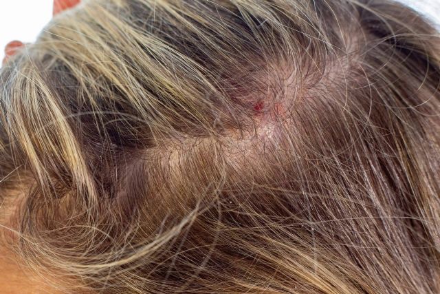 legumbres venganza Floración EMPRESA / Dermatitis seborreica es una afección que puede generar alopecia  si no se trata - murcia.com