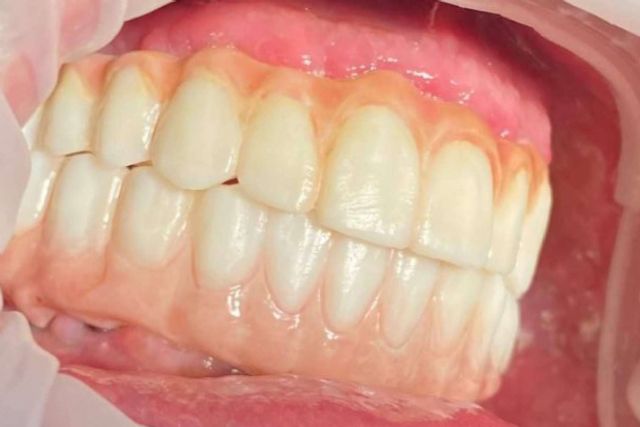 Dientes en un día es posible con la impresión 3D, por Dentinova - 1, Foto 1