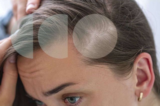 Este año la caída de cabello estacional viene más fuerte - 1, Foto 1