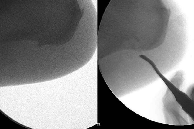 La solución definitiva para la fascitis plantar y el espolón calcáneo - 1, Foto 1