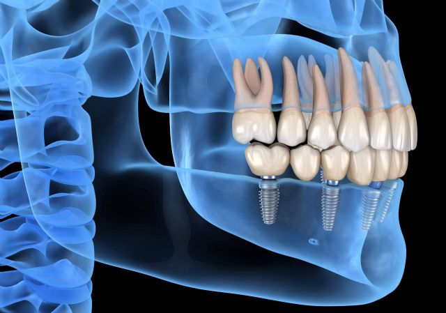 La Clínica Dental de la Doctora Cachero ofrece implantes dentales - 1, Foto 1