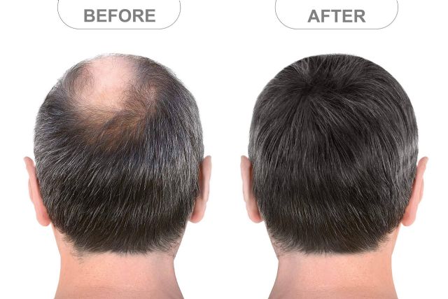 Microinjerto capilar FUE, solución definitiva y mínimamente invasiva para los casos de alopecia androgénica - 1, Foto 1