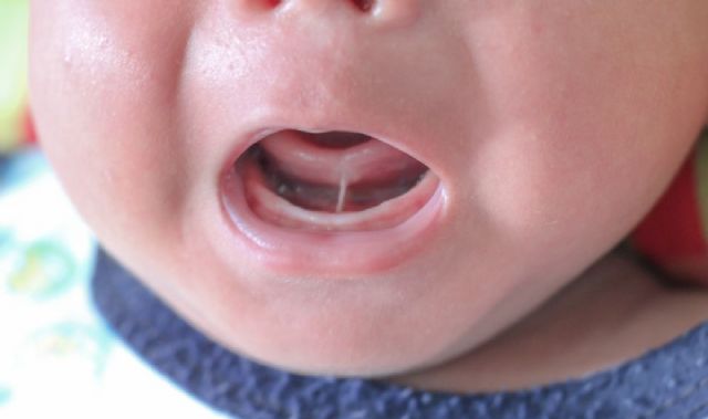 La Sociedad Española de Cirugía Oral y Maxilofacial y de Cabeza y Cuello (SECOMCYC) alerta de un elevado número de cirugías de frenillo lingual innecesarias - 1, Foto 1