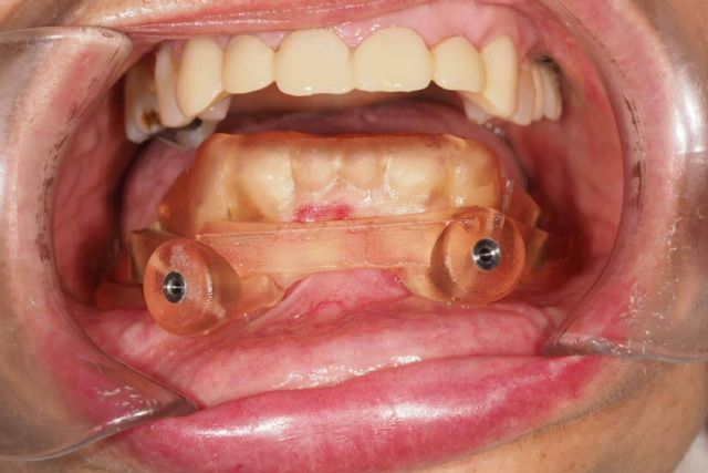 Implantes dentales en los casos más complicados, de la mano de Centro Nacional de Cirugía Bucomaxilofacial e Implantes - 1, Foto 1