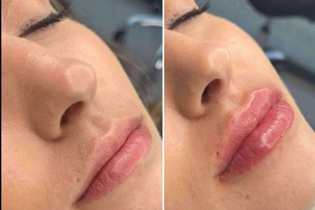 Clínica MG Dental & Estética Facial, especialistas en vial ácido hialuronico labios - 1, Foto 1