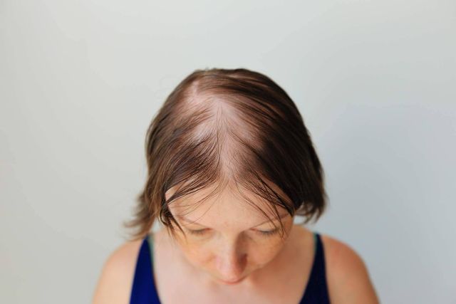 Alopecia femenina. ¿Cómo detectarla y qué tratamientos son los adecuados? - 1, Foto 1