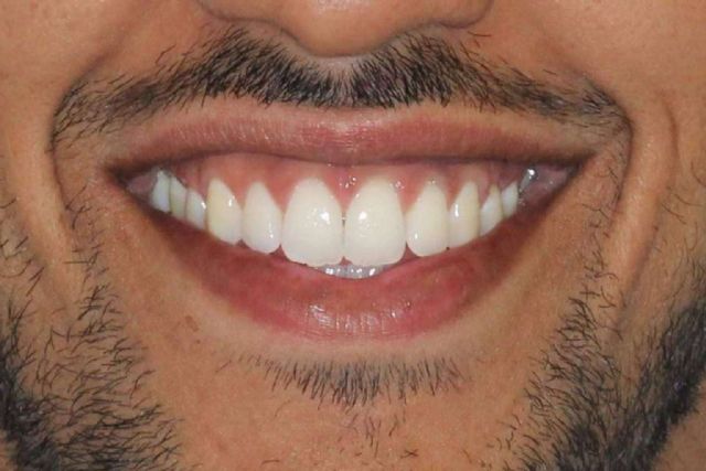 Los servicios de blanqueamientos dentales de la Clínica Zahara - 1, Foto 1