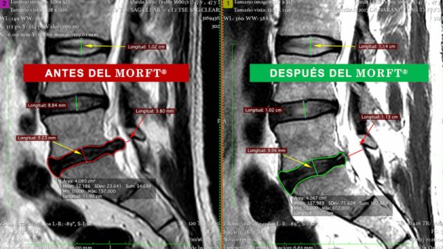 El método MORFT® rehabilita a pacientes que viven con protusión y/o hernia discal sin medicamentos ni cirugías - 1, Foto 1