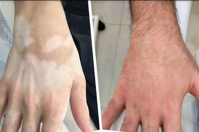 Dermopigmentación Clínica dispone del TERAV tratamiento estético de repigmentación artificial para vitiligo - 1, Foto 1