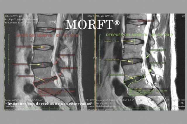 La regresión discal de las hernias con el método MORFT® - 1, Foto 1