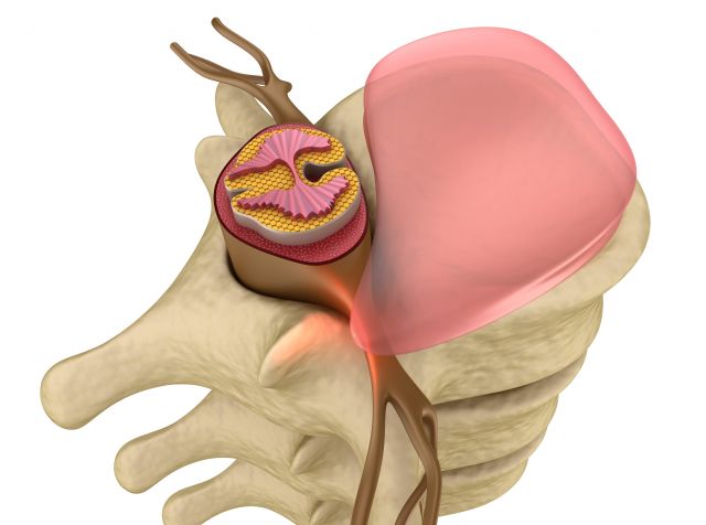 Medicina regenerativa en hernia discal: detrás de la curación mediante la respuesta inmunológica - 1, Foto 1