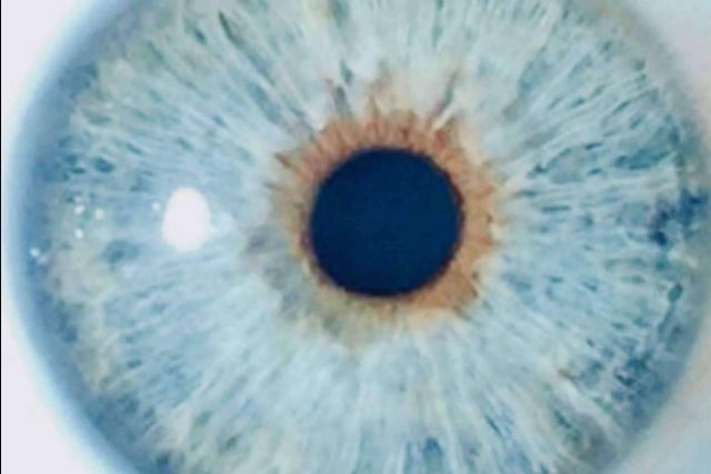 Después de la iridoplastia láser, Clínica Eyecos demuestra un riesgo mínimo de glaucoma crónico - 1, Foto 1