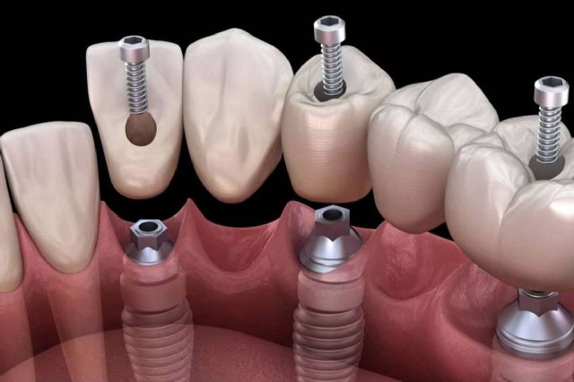 ¿Dónde encontrar un servicio de colocación de implantes? Dental Implantologie - 1, Foto 1