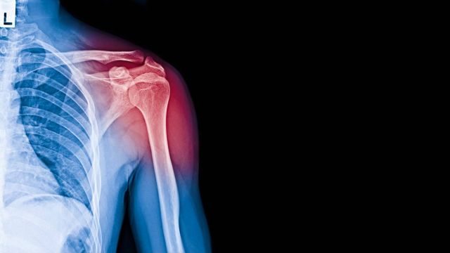 ¿Qué es todo lo que hay que saber sobre la tenditis de supraespinoso?, por el Dr. Miguel Romero - 1, Foto 1