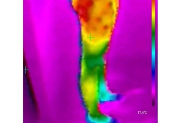 Saber cuál es el tipo de celulitis con la cámara termográfica es posible - 1, Foto 1