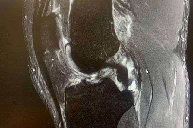 La prevención de las lesiones de ligamento cruzado anterior, por Regeneractiva - 1, Foto 1