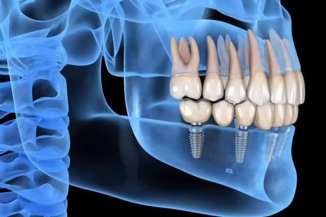 Recuperar la mejor versión de la sonrisa con los implantes dentales inmediatos de DeltaDent - 1, Foto 1