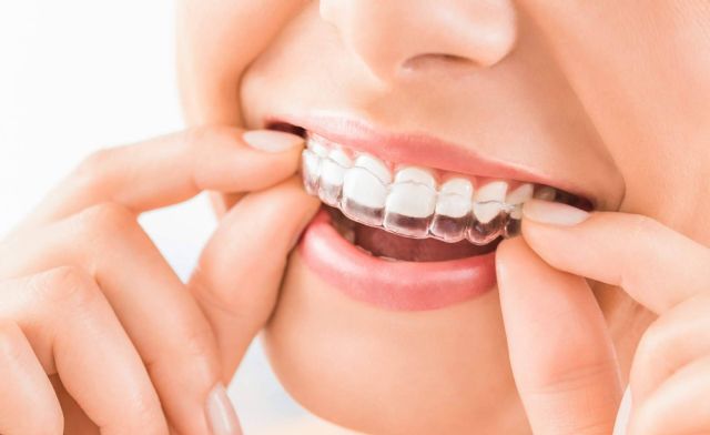 InterORALIA explica los beneficios de la ortodoncia Invisalign - 1, Foto 1