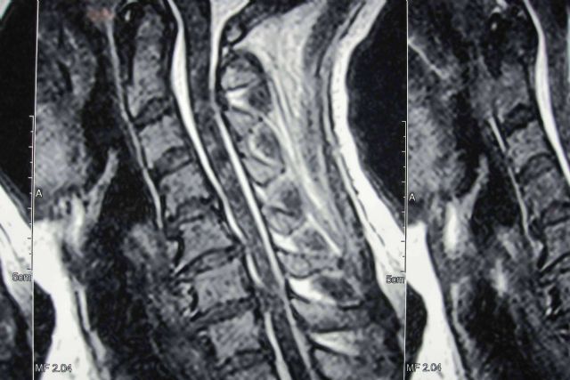 ¿Qué es la hernia disco cervical?, por Neurocirugía Galarza - 1, Foto 1