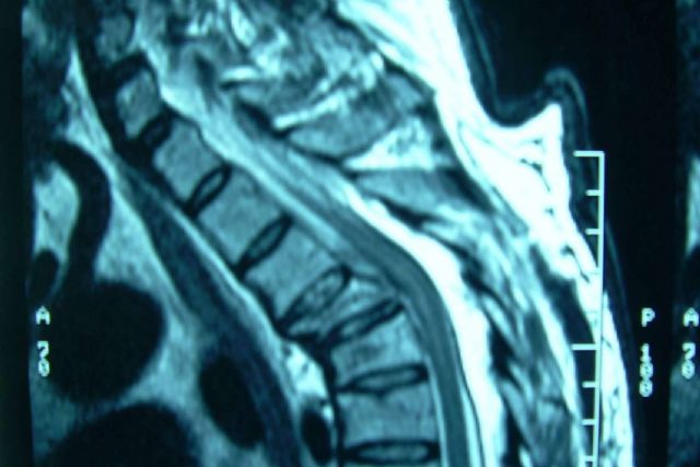 Neurocirugía Galarza sobre las fracturas vertebrales - 1, Foto 1