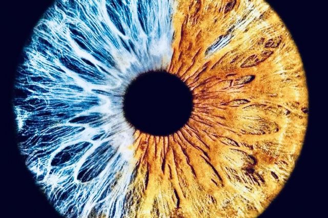 La pigmentación de los ojos se puede clasificar en 5 grados, según Eyecos - 1, Foto 1