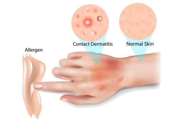 EQuaid Pomada es una solución rápida y eficaz para la dermatitis - 1, Foto 1