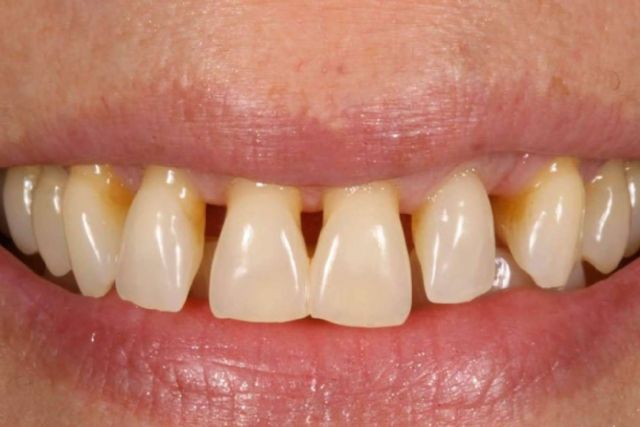 ¿Cómo tratar la gingivitis?, con Clínica Dental Ruiz de Gopegui - 1, Foto 1