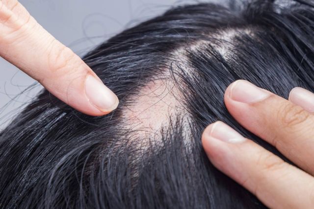 Tratamientos para la alopecia androgénica con Saw Palmetto - 1, Foto 1