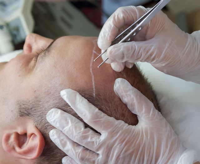 El pelo propio es la elección más segura y natural para el trasplante capilar   - 1, Foto 1