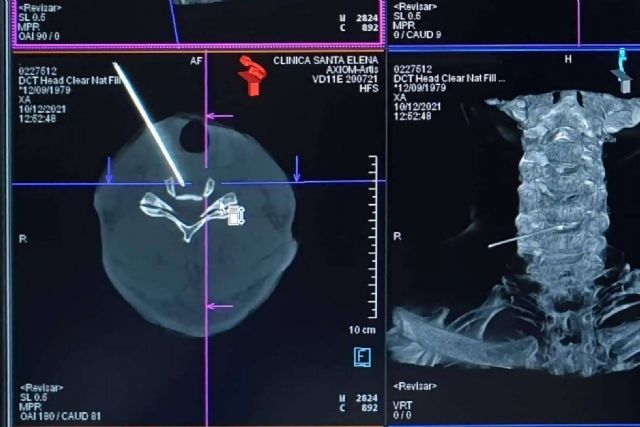 El 82% los pacientes con hernia discal responden al tratamiento láser, en una sola sesión - 1, Foto 1