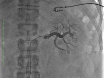 Dr. José Ramón Rumoroso: La denervación renal es una alternativa para pacientes con hipertensión no controlada - 1, Foto 1