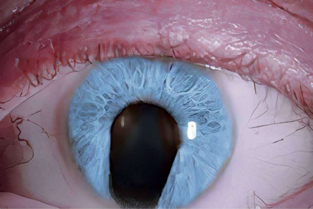 El tratamiento del coloboma del iris es únicamente quirúrgico - 1, Foto 1