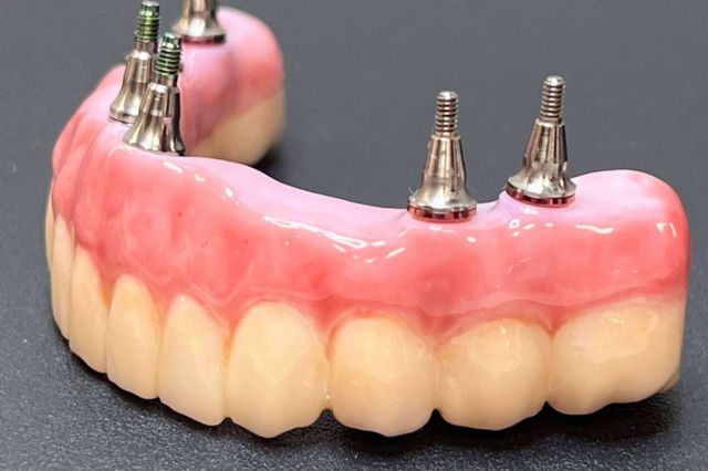 Los servicios de Dentinova permiten realizar implantes y extracciones dentales inmediatos en una misma sesión - 1, Foto 1